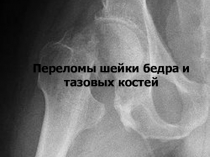 Презентация по теме: Переломы таза и шейки бедра