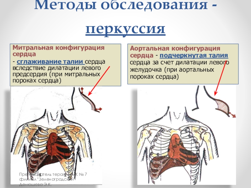 Презентация пороки сердца пропедевтика