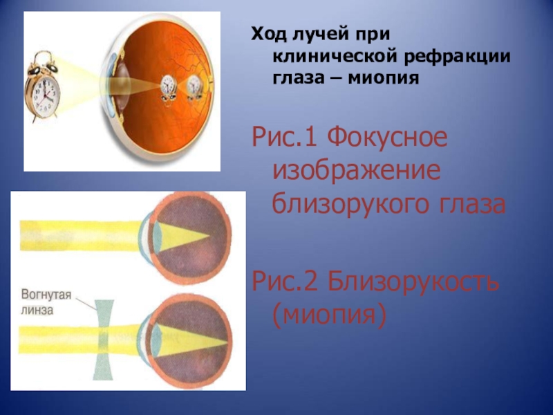 Тест по биологии 8 класс зрительный анализатор. Рефракция глаза миопия. Близорукость ход лучей в глазе. Ход лучей в близоруком глазу. Ход лучей при различной клинической рефракции глаза.