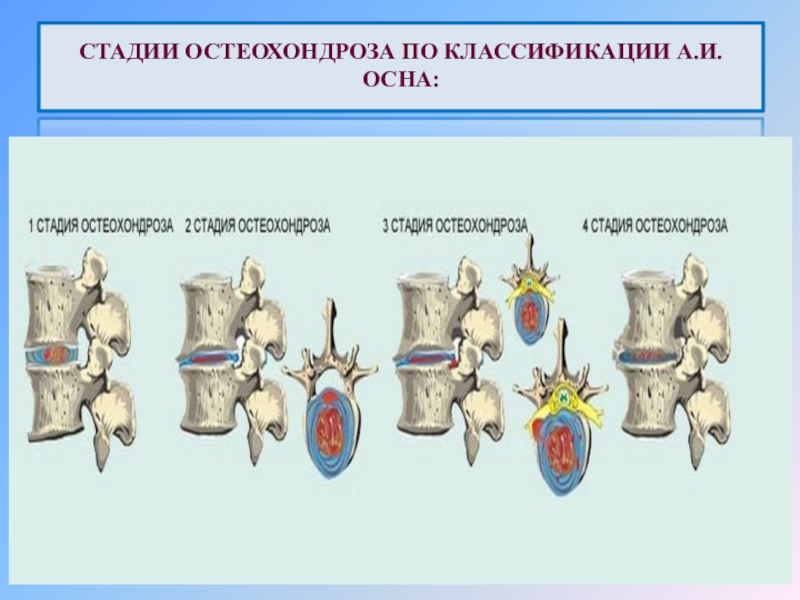Схема лечения шейного остеохондроза в стадии обострения