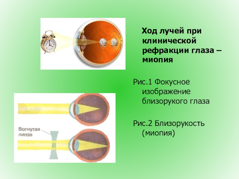 Рефракция глаза презентация