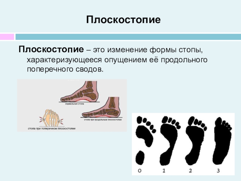 Продольное плоскостопие презентация