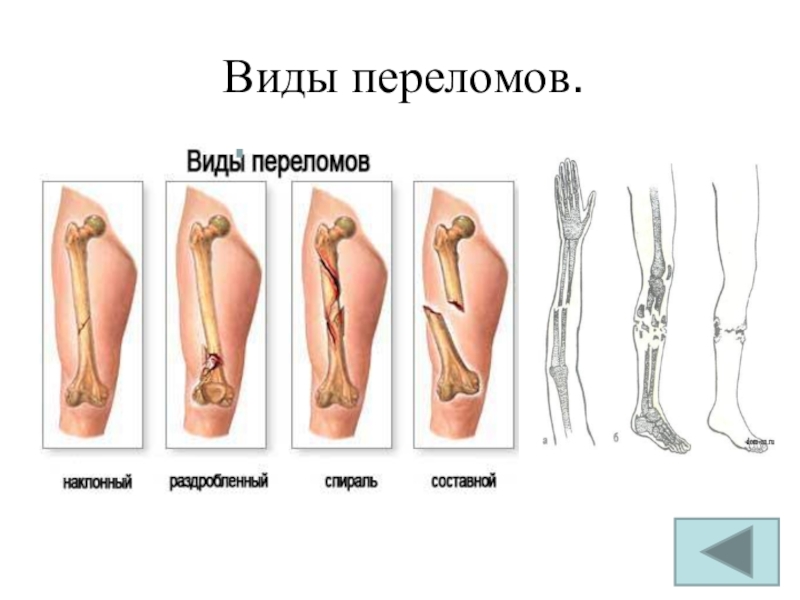 Презентация про переломы