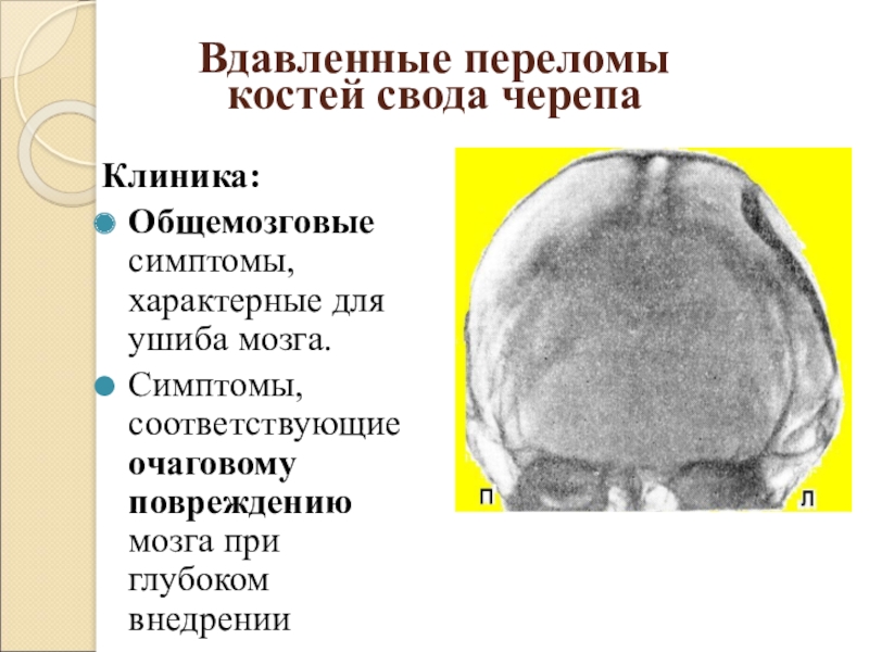 Перелом свода и основания черепа фото Картинки ПЕРЕЛОМ СВОДА