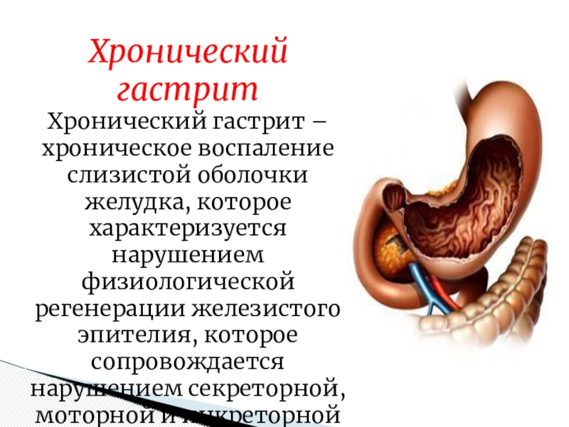 Презентация гастрит и дуоденит