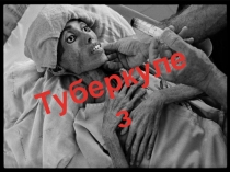 Туберкулез. Описание проблематики и ее купирование.
