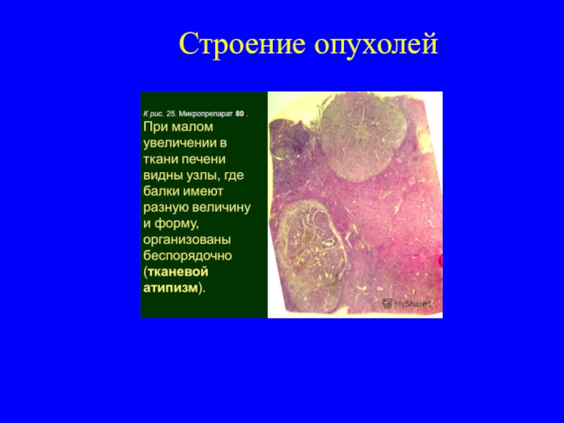 Строение опухоли картинка