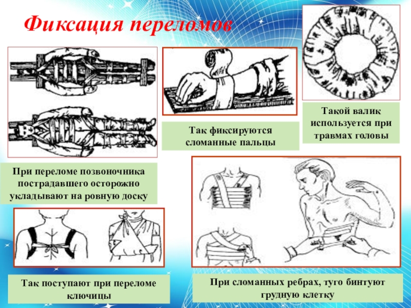 Первая помощь при ушибах и растяжениях вывихах и переломах 9 класс презентация