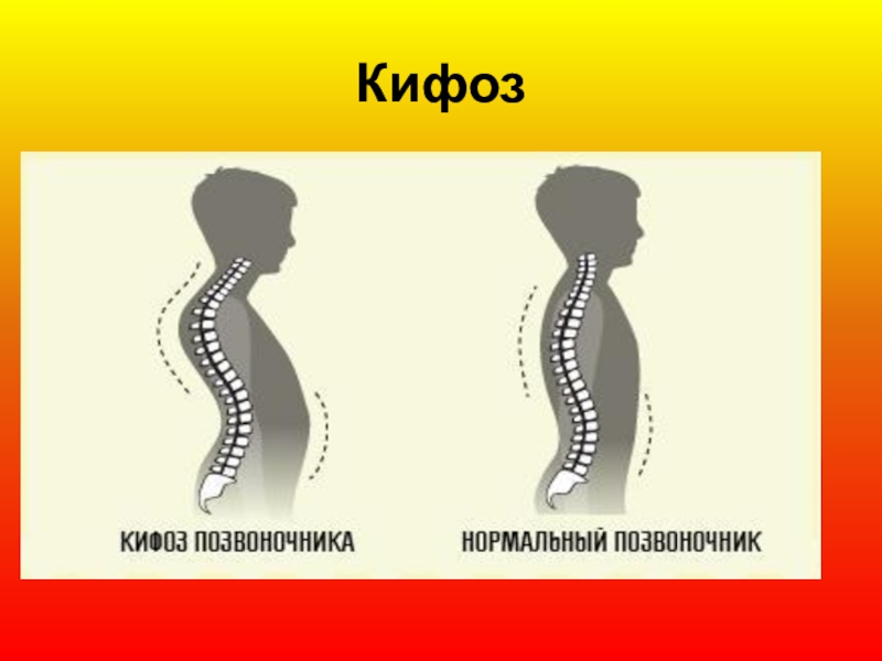 Кифоз что это. Кифоз позвоночника. Кифоз и нормальная спина. Дугообразный кифоз. Патологический кифоз.