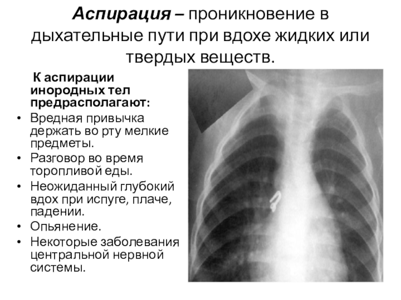 Аспирация верхних дыхательных путей карта вызова