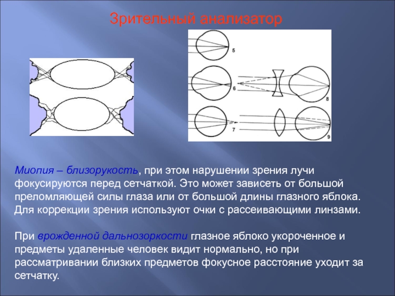 Так как у них изображение фокусируется перед сетчаткой