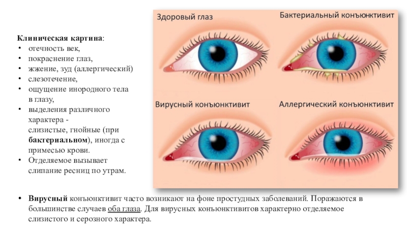 Конъюнктивит сколько. Бактериальный конъюнктивит. Конъюнктивит у детей Комаровский. Бактериальный конъюнктивит глаз. Конъюнктивит у детей начальная стадия.