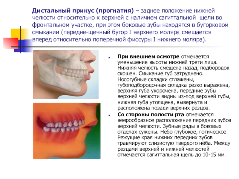 Верхнечелюстная прогнатия. Прикусы зубов прогнатия. Открытый прикус при прогнатии. Аномалии прикуса прогнатия.