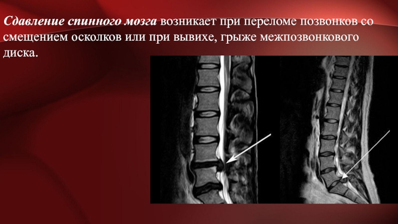 Травмы позвоночника и спинного мозга клиническая картина