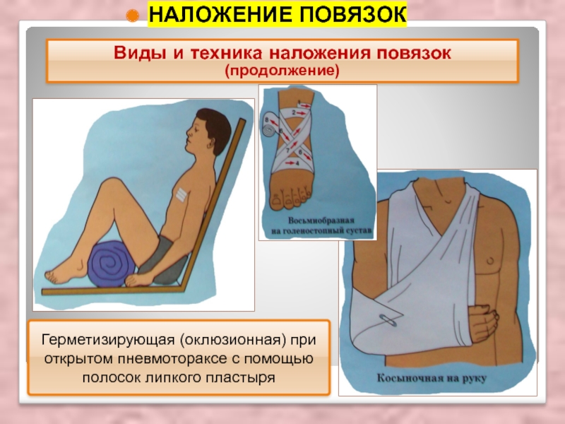 Окклюзионная повязка при пневмотораксе алгоритм. Наложить повязку при открытом пневмотораксе. Наложение окклюзионной (герметизирующей) повязки. Наложение герметизирующей повязки при пневмотораксе.