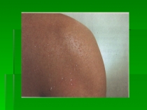 Презентация по биологии на тему Строение и функции кожи