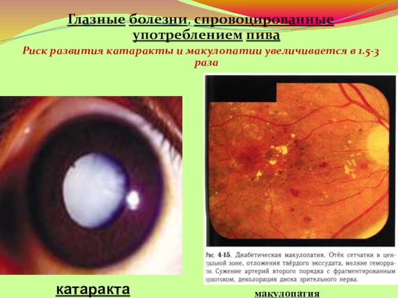 катаракта и конопля