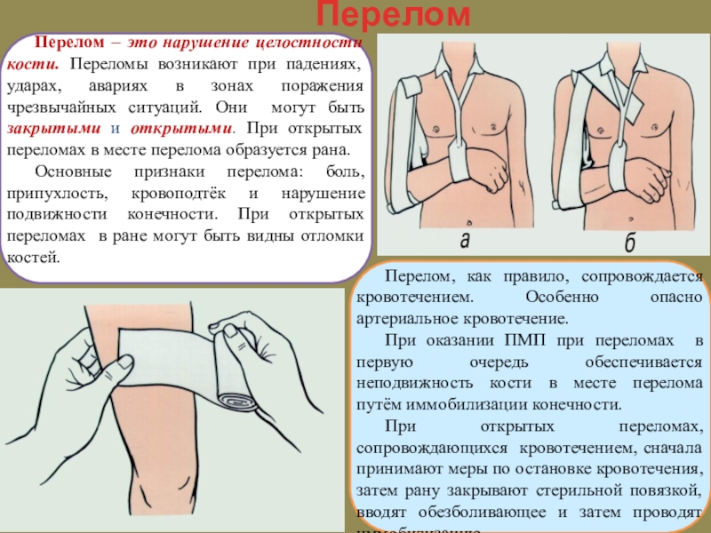 Презентация по обж 7 класс первая помощь при переломах