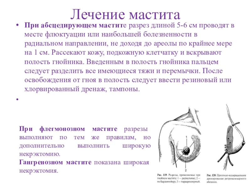 Схема хирургических разрезов при маститах