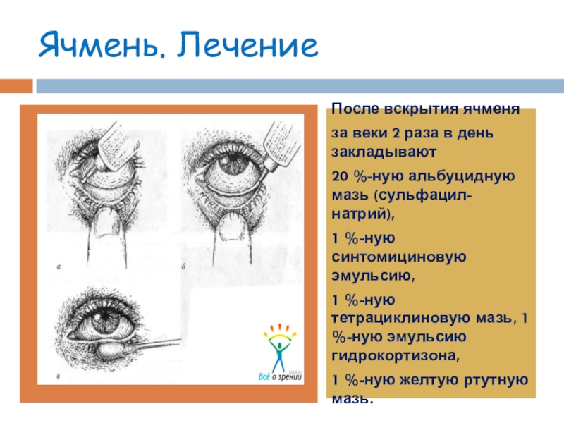 Придаточный аппарат глаза. Ячмень на глазу после вскрытия. Ячмень медицинское название.