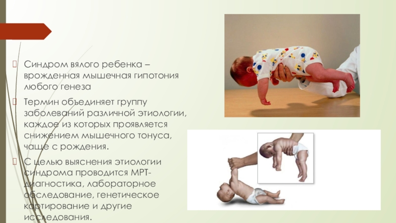 Синдром вялого ребенка. Синдром мышечной гипотонии. Мышечная гипотония у детей. Гипотонус мышц у грудничков.