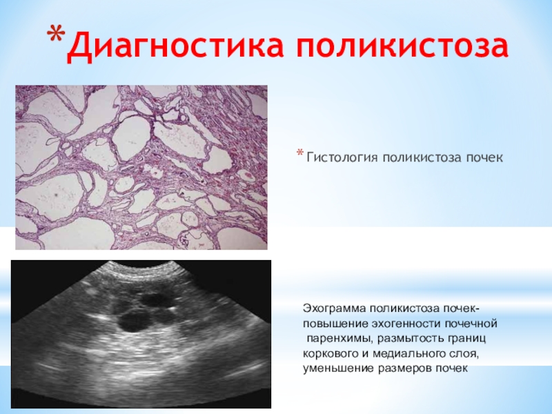 Поликистоз инфильтративного типа мелкокистозного типа дает эхографическую картину