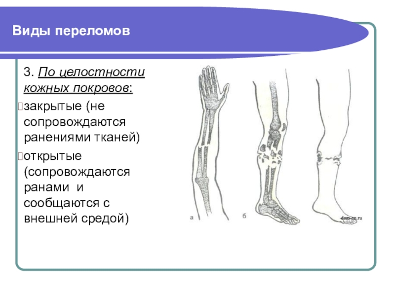 Целостность кожного покрова. Переломы по целостности кожных покровов. Виды переломов по целостности кожного Покрова. Переломы по признаку целостности. Виды травм по целостности костных покровов.