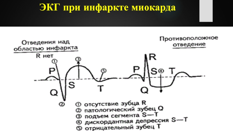 Инфаркт миокарда на экг расшифровка фото и обозначения