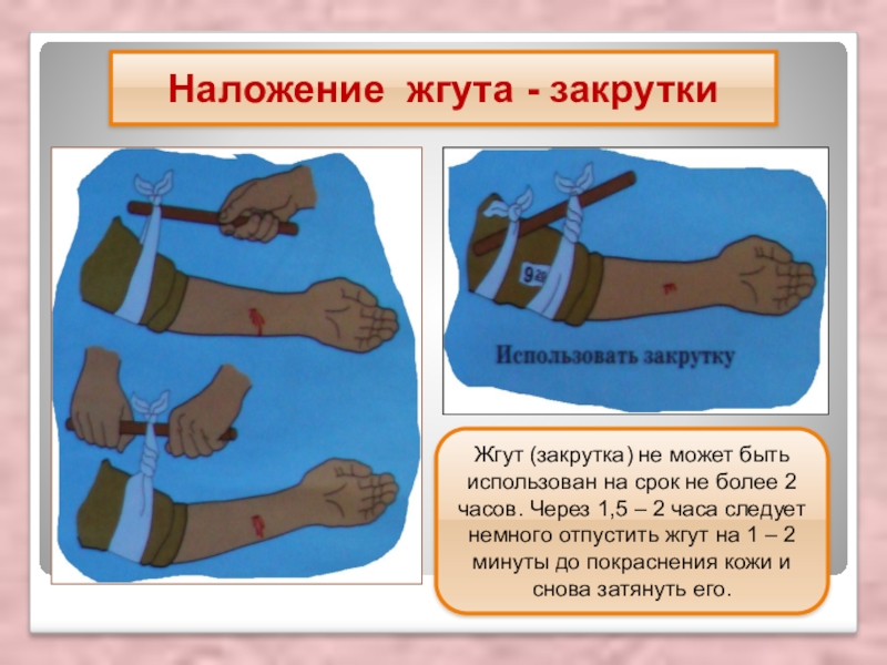 Наложение жгута. Наложение кровоостанавливающего жгута Эсмарха. Наложение жгута при кровотечениях Эсмарха.