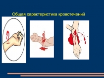 Презентация общая характеристика кровотечений