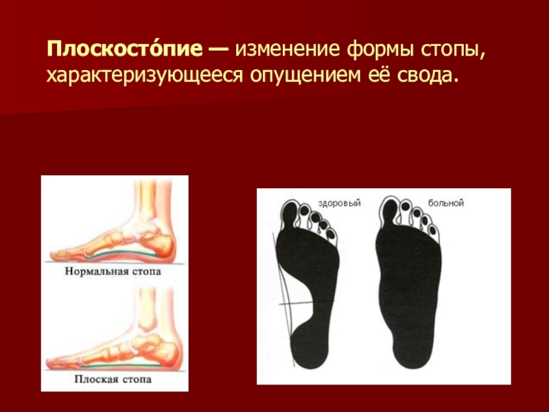 Реферат: Осанка и плоскостопие