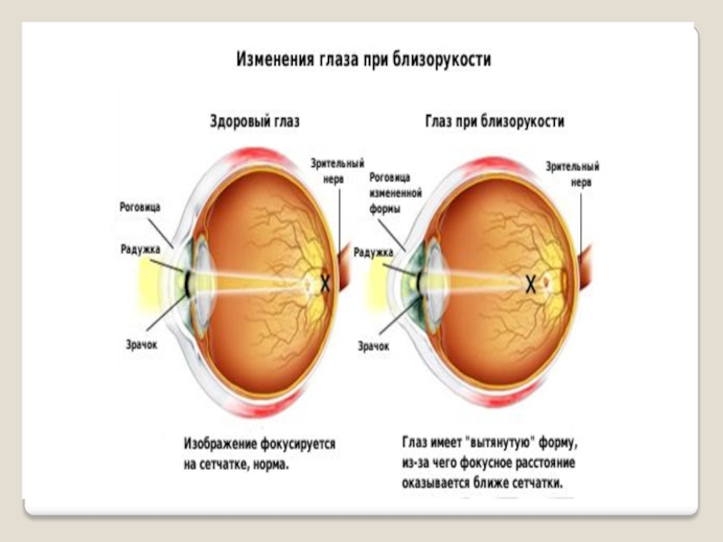 Изменения глаз. Строение глаза при миопии. Изменение глаза при близорукости. Близорукость строение глаза. Здоровый глаз близорукость.