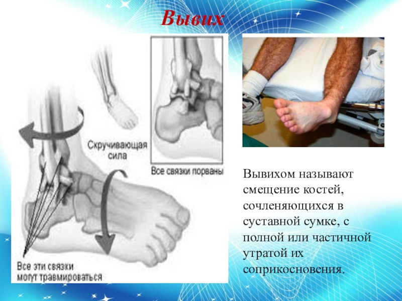 Повреждения голени презентация травматология