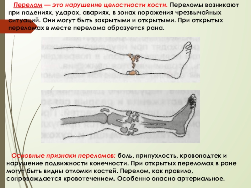 Первая помощь при открытых переломах костей