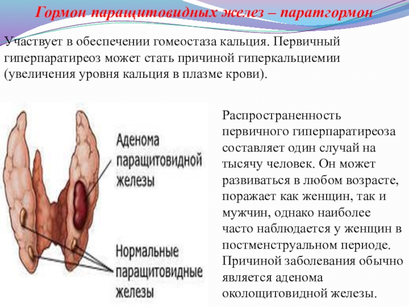 Гиперплазия паращитовидной железы