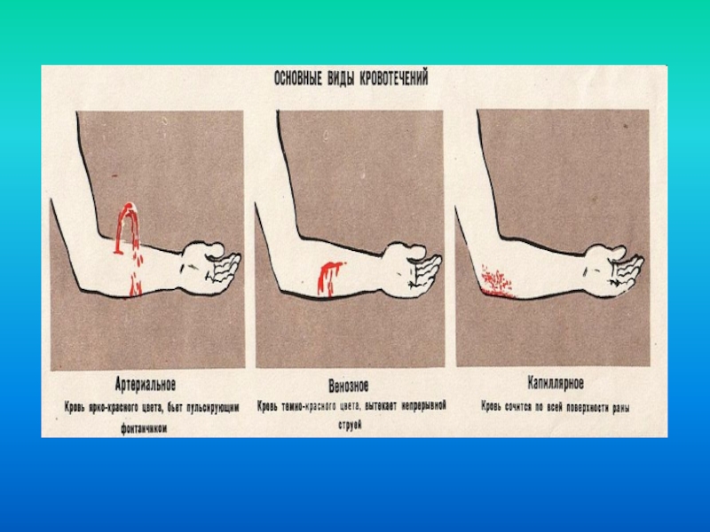 Найди какое кровотечение изображено на рисунке