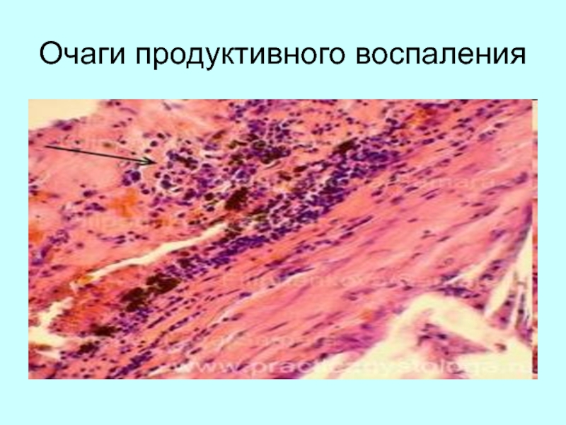 Воспаление патология презентация