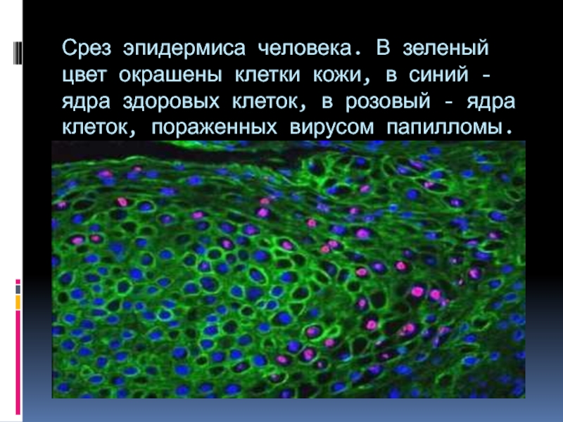 Срез эпидермиса человека. В зеленый цвет окрашены клетки кожи, в синий - ядра здоровых клеток, в розовый