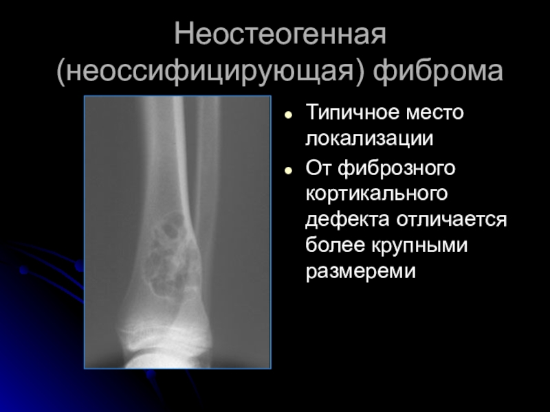 Фиброма кости. Фиброзный кортикальный дефект. Фиброзный кортикальный дефект большеберцовой кости кт. Неоссифицирующая фиброма кт. Дефект кортикального слоя.