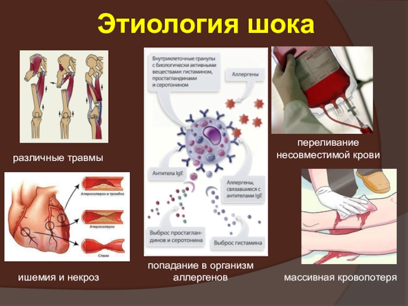 Ишемия презентация патофизиология