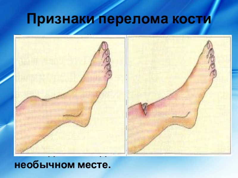 Перелом признаки. Признаки перелома кости на ноге. Симптомы закрытого перелома.