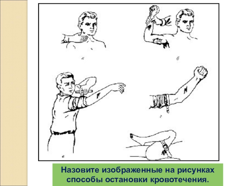 Какое кровотечение изображено на рисунке 1 и 2 чем отличаются