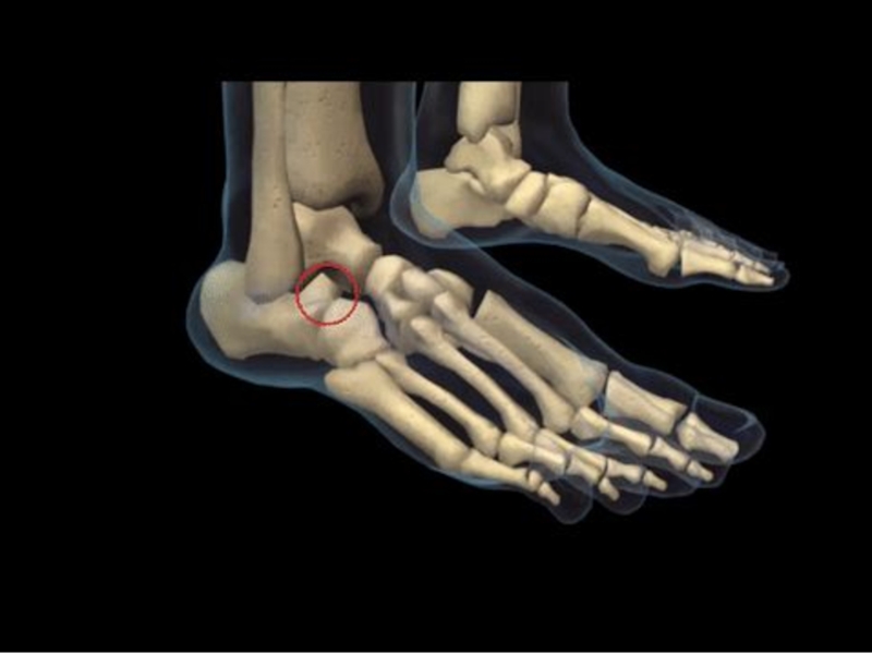 Скелет стопы человека фото перелом