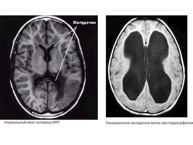 Норма желудочков мозга у взрослых. Желудочки головного мозга кт анатомия. Тетравентрикулярная гидроцефалия кт.