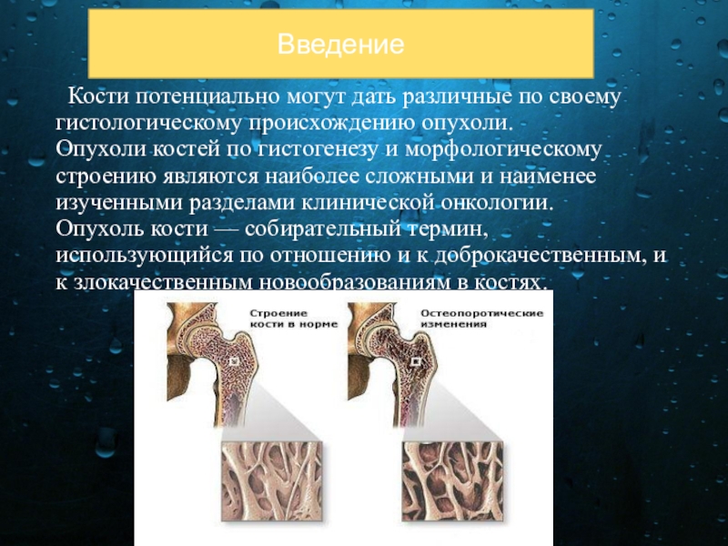 Злокачественные опухоли костей презентация