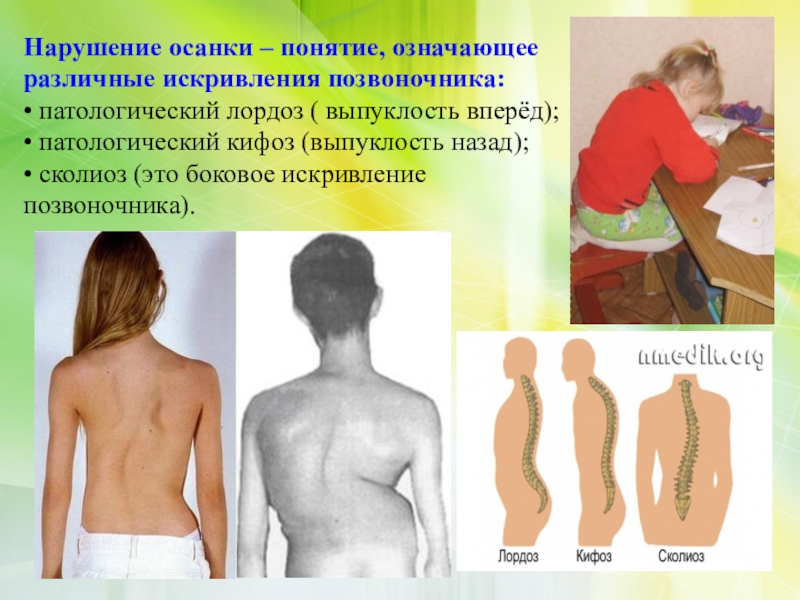 Нервно мышечный сколиоз клинические рекомендации