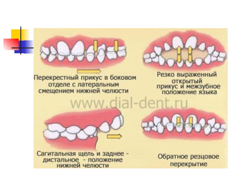 Перекрестный прикус схема