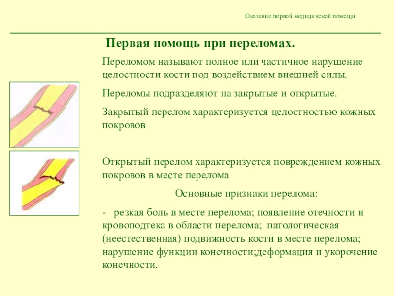 Частичное нарушение. Первая помощь при нарушении целостности кости. Полное или частичное нарушение целостности кости. Переломы виды переломов первая помощь. Перелом характеризуется.