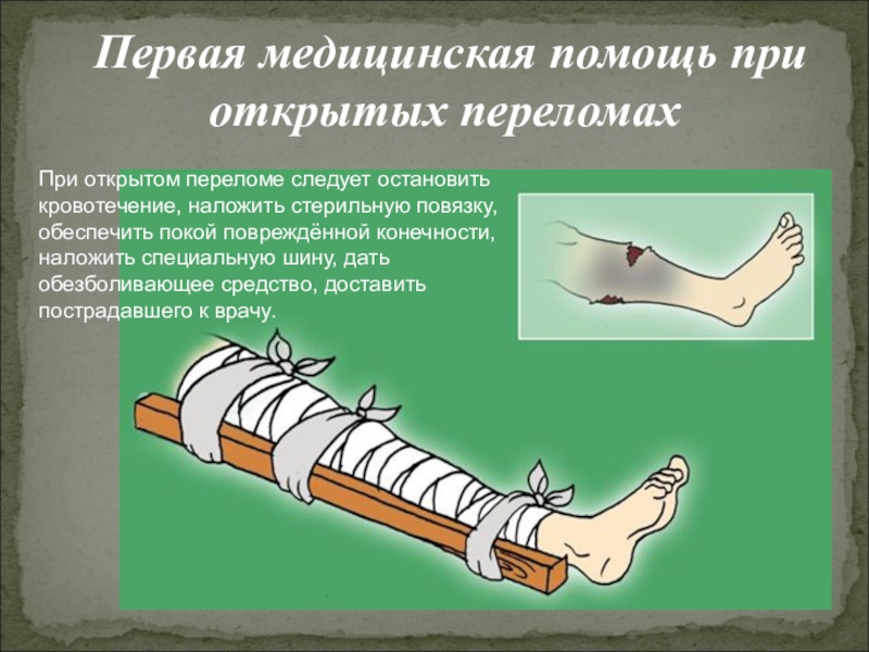 Если при открытом переломе имеется повреждение артерии. Оказание первой помощи при переломе ноги. Первая помощь припереломаз. ПМП при открытом переломе конечности. Наложение повязки при открытом переломе.