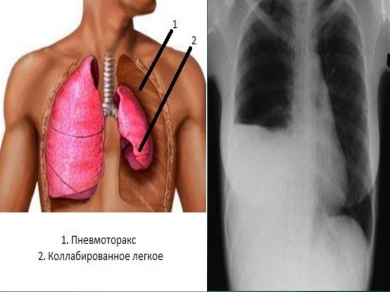 Спонтанный пневмоторакс картинки